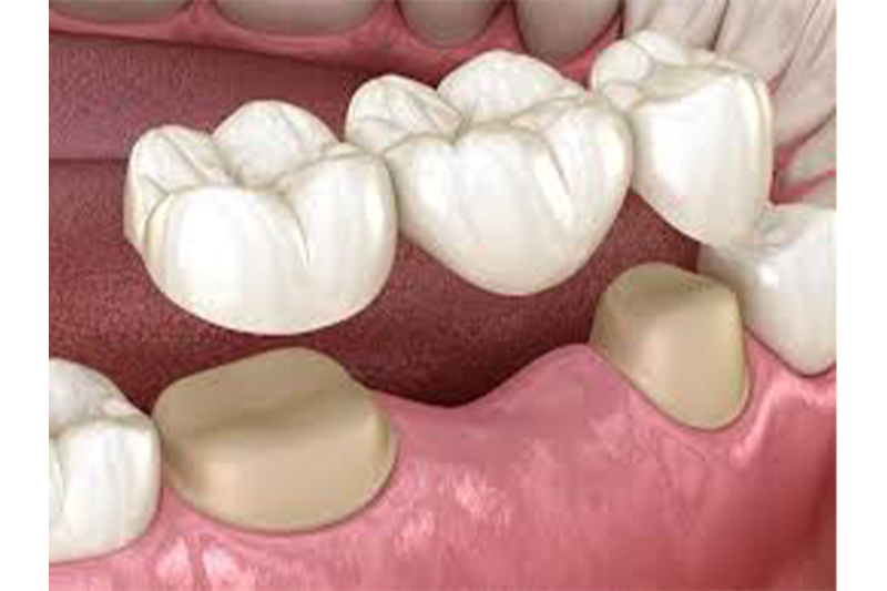 Dental Bridges in Dallas